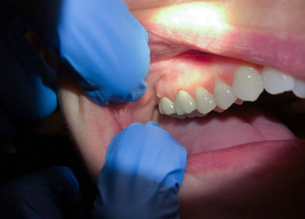 Best Broken or Chipped Tooth Repair in Pella, IA
